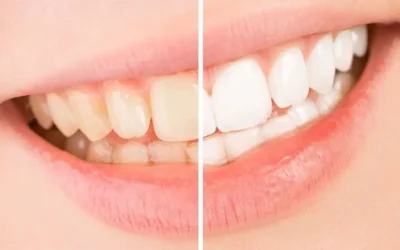 FAQs on Teeth Whitening