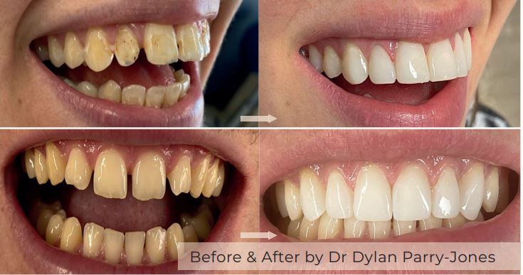 dental treatment, before and after