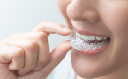 Straighten Your Teeth Without the Hassle Using Invisalign