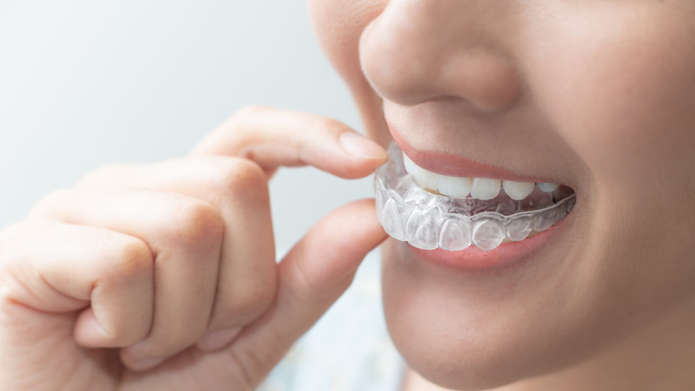 Invisalign Cemaes Bay