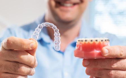 How Invisalign Aligners Feel Compared to Braces
