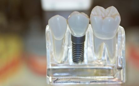 Medical Conditions That Can Affect Dental Implant Success