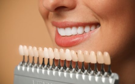 What Are Dental Veneers and How Do They Work?