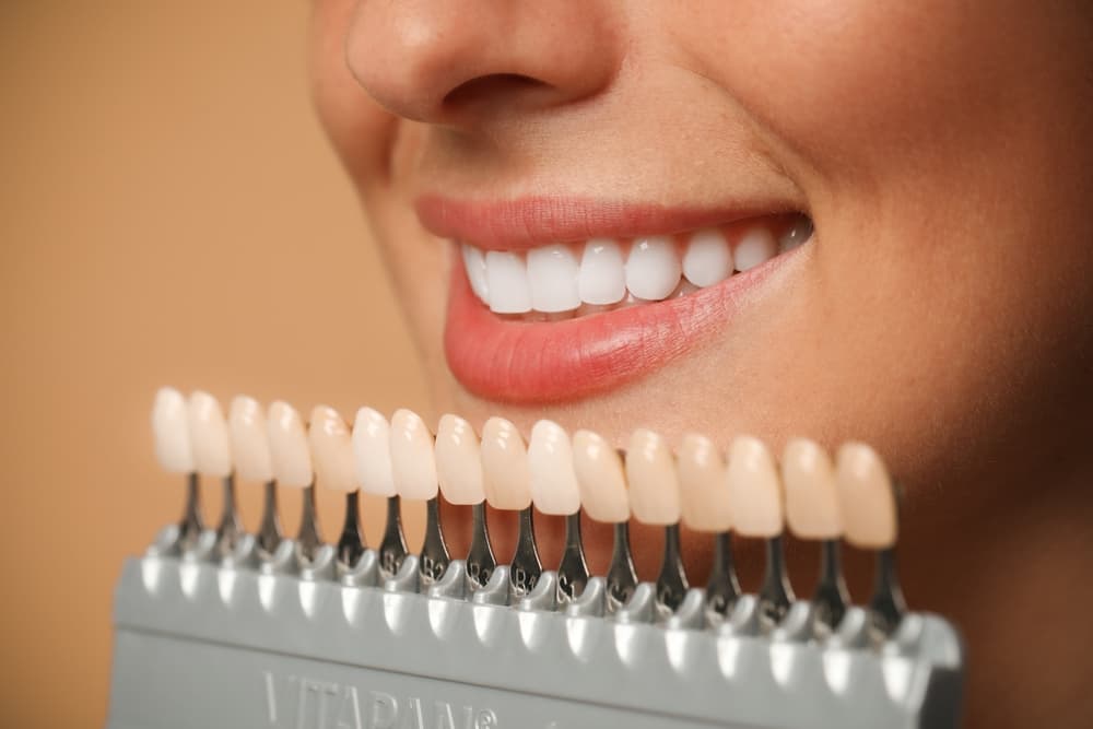 Dental Veneers