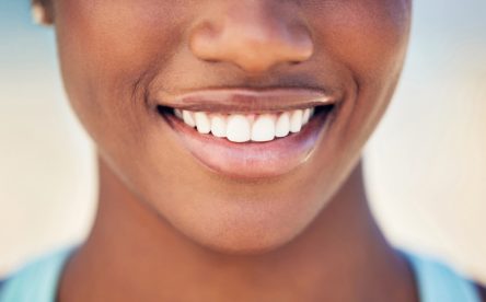 How to Care for Your Veneers at Home
