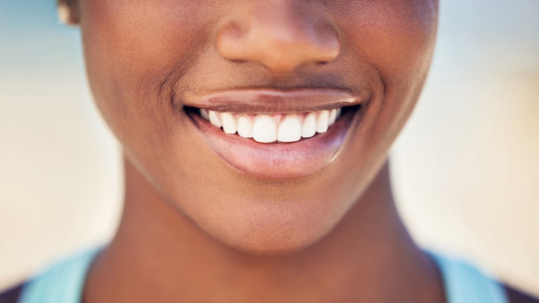 dental veneers